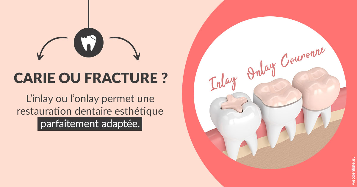 https://dr-aurelie-gonzalez.chirurgiens-dentistes.fr/T2 2023 - Carie ou fracture 2