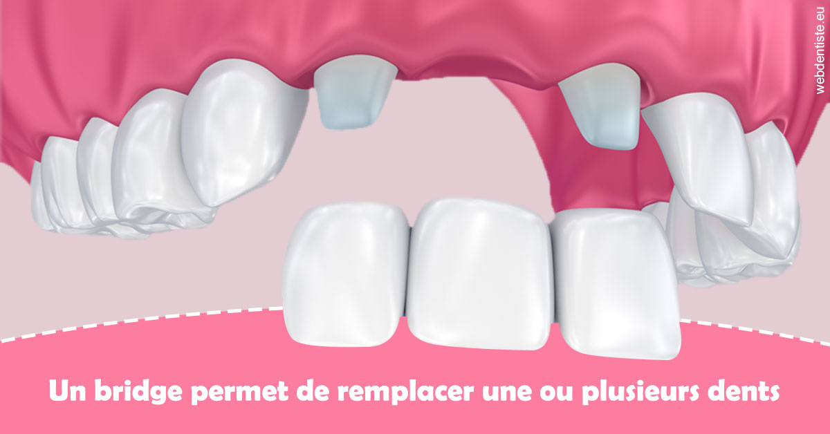 https://dr-aurelie-gonzalez.chirurgiens-dentistes.fr/Bridge remplacer dents 2