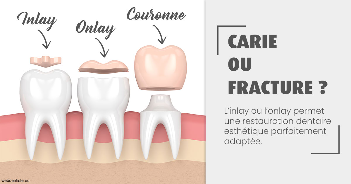https://dr-aurelie-gonzalez.chirurgiens-dentistes.fr/T2 2023 - Carie ou fracture 1