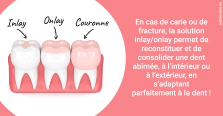 https://dr-aurelie-gonzalez.chirurgiens-dentistes.fr/L'INLAY ou l'ONLAY 2
