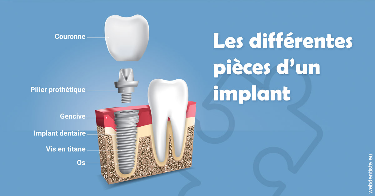 https://dr-aurelie-gonzalez.chirurgiens-dentistes.fr/Les différentes pièces d’un implant 1