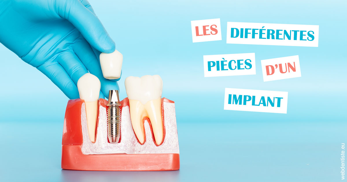 https://dr-aurelie-gonzalez.chirurgiens-dentistes.fr/Les différentes pièces d’un implant 2